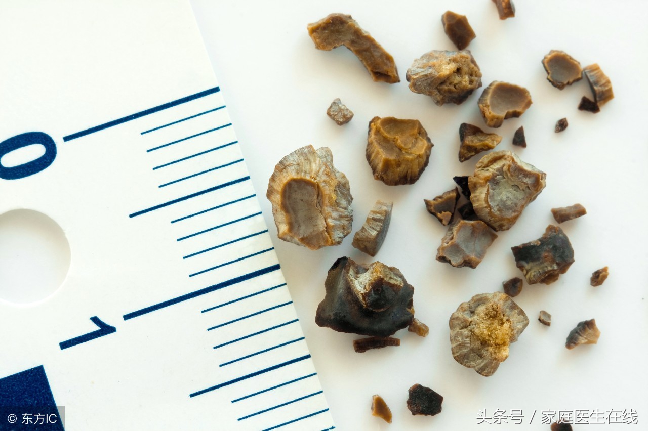 肾里为什么会长结石？6个诱因，弄清楚了记得躲开