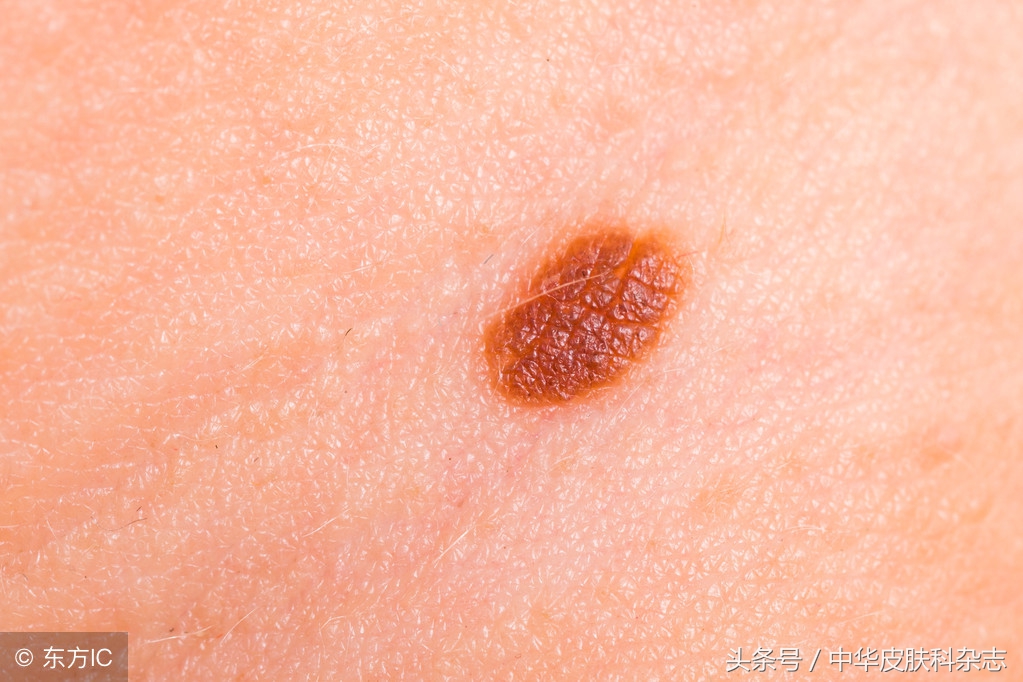 对于新生儿胎记,家长该如何对待?