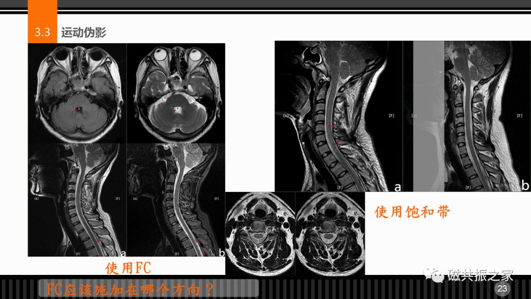 磁共振常见伪影及策略