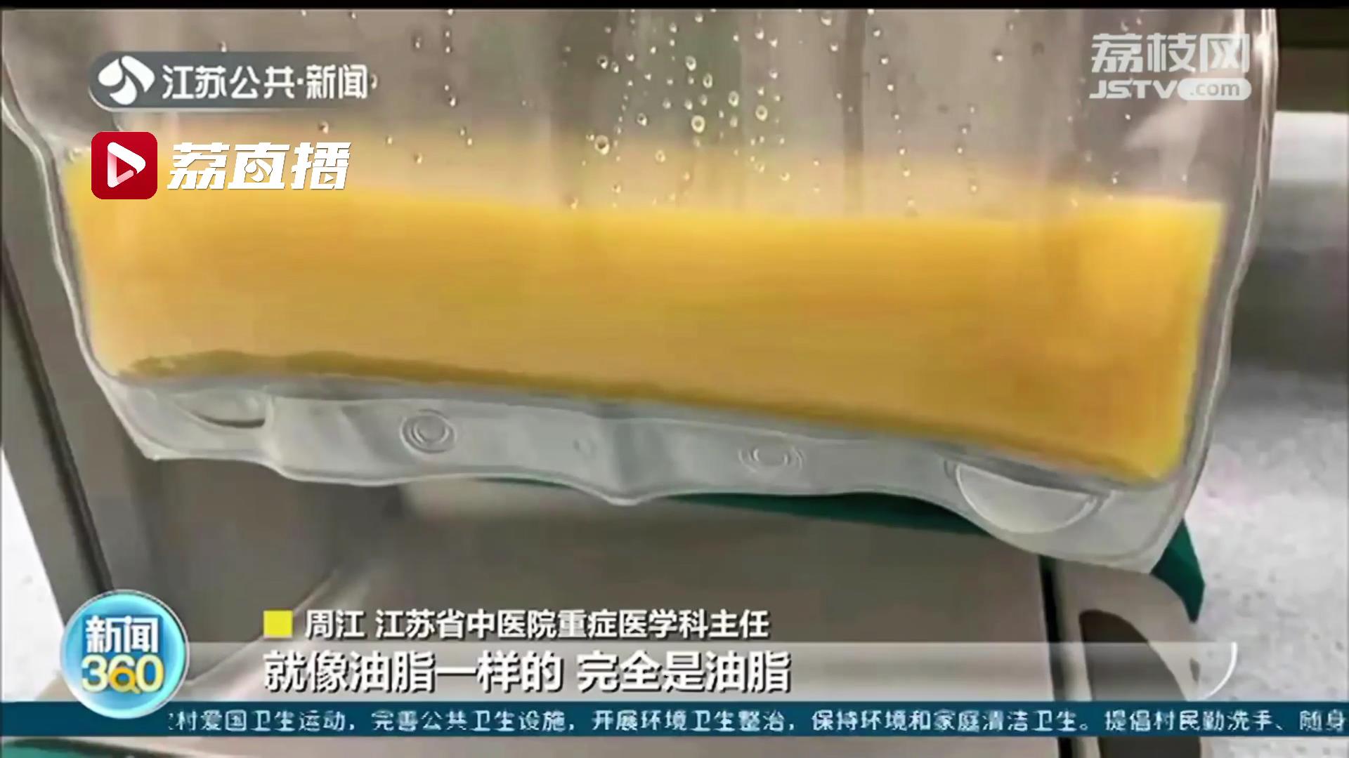 悠着点！大餐过后诱发急性胰腺炎 患者身体抽出&ldquo;黄油血&rdquo;