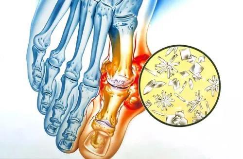 尿酸達到這個值就得開始服藥了！ 各類降尿酸藥有何特點？