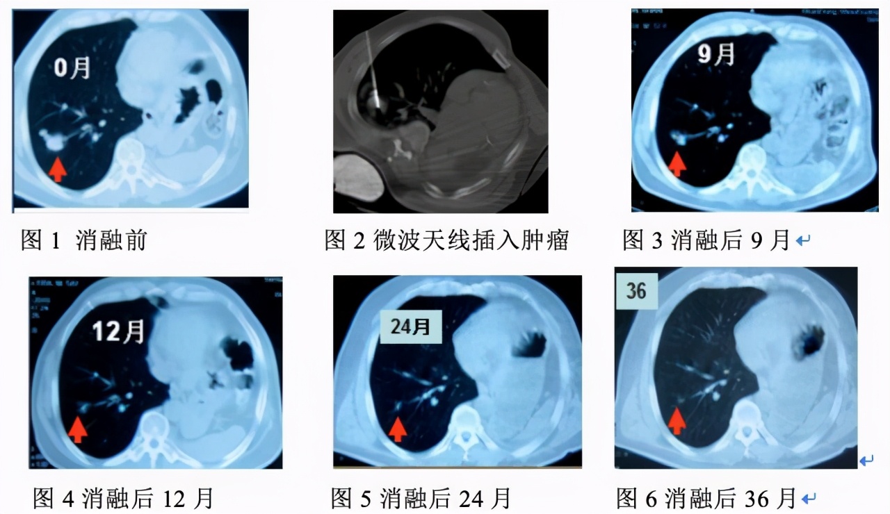 高温“烫死”癌细胞，已证实有效！损伤小恢复快，针对多种癌症