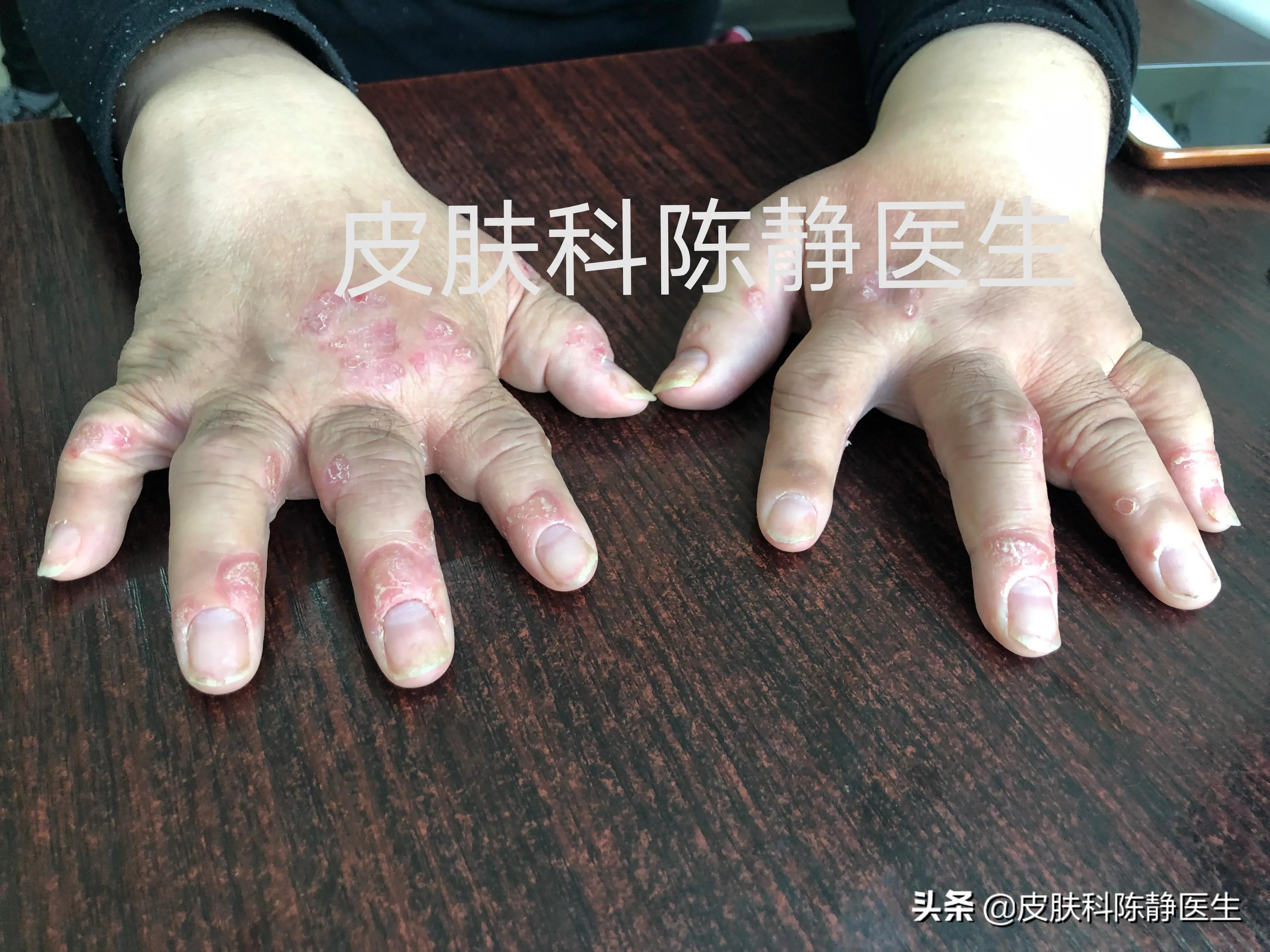 众所周知的银屑病并发症,两者易感基因在很大程度上是重叠的.