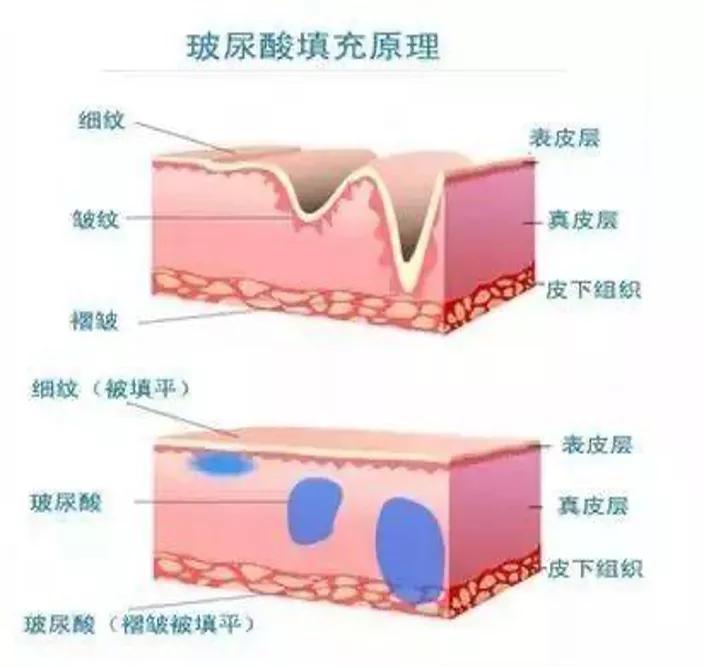 美容针你知多少？