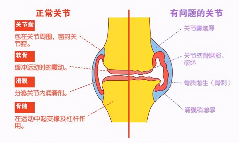膝关节由股骨内,外侧髁和胫骨内,外侧髁以及髌骨构成,为人体最大且