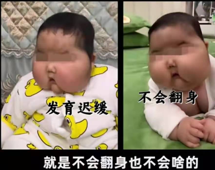 因用护肤霜，3个月的婴儿额头长满浓密汗毛，体重猛增但身高不长