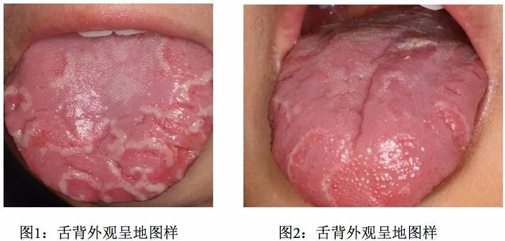 舌头上长了 地图 多发于小儿 常见病因有哪些 药说健康 Mdeditor