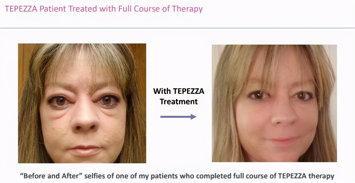 首个甲状腺眼病药物：显著改善眼球突出，停药后疗效持续一年