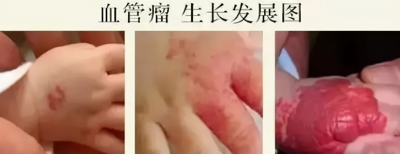 婴幼儿血管瘤服用普萘洛尔，这些细节不可忽视