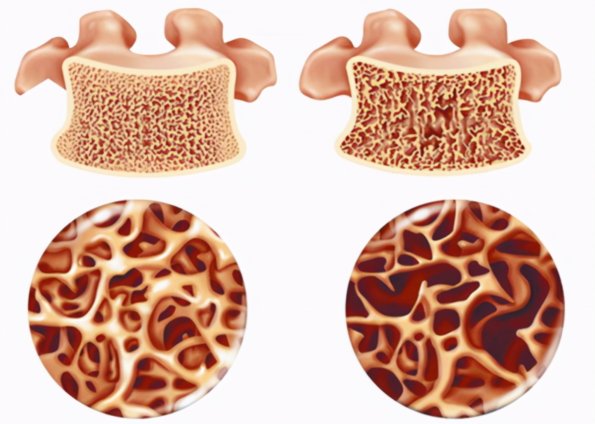 中老年人如何防治骨質疏鬆？ 不能只補鈣，還需做好這4件事