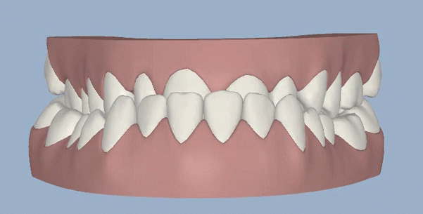 牙齿矫正一半靠医生一半靠自己