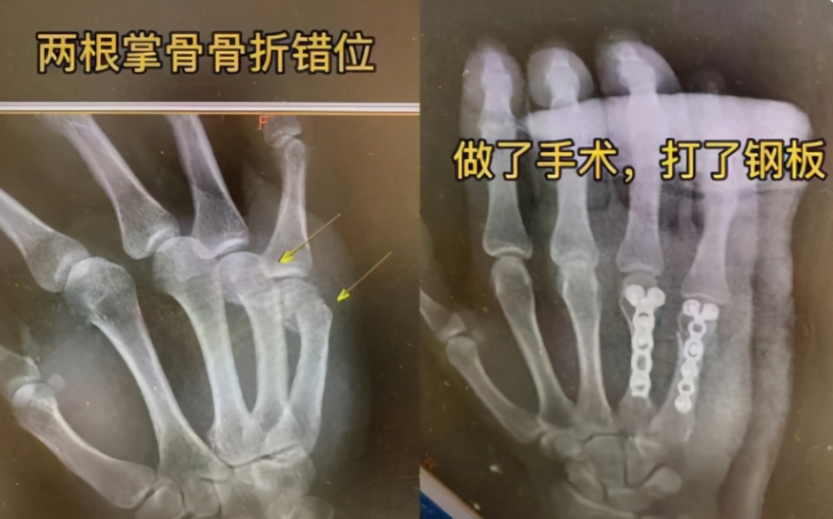 寶爸因輔導孩子寫作業 生氣捶牆致手骨折 網友表示感同身受 優秀父母育兒經 Mdeditor