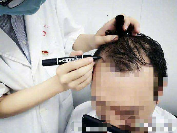 疯狂|24岁小伙疯狂健身后险些秃头 运动：这锅我不背