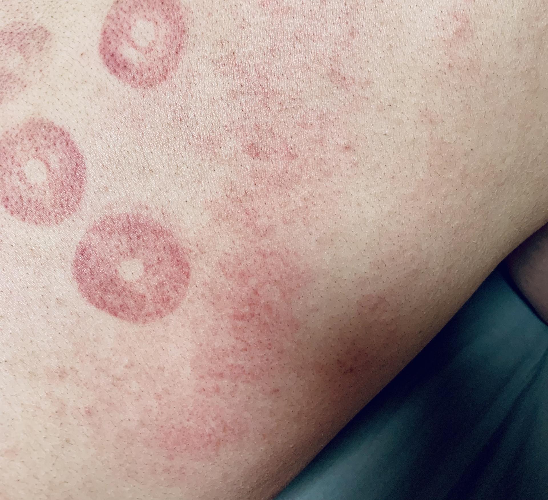 走罐智能化是怎样的体验？左点智能走罐按摩器上手，开启智能养生