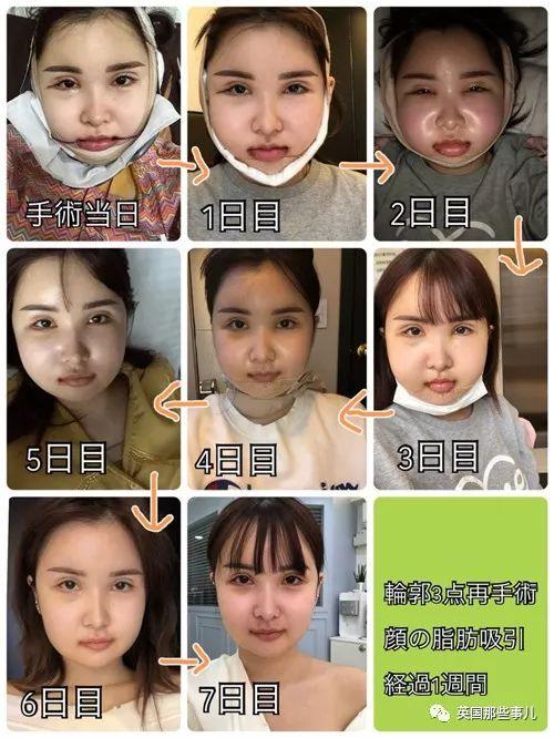 被爹说“你的长相会给他人带来不幸”，她花1500万日元反复整容