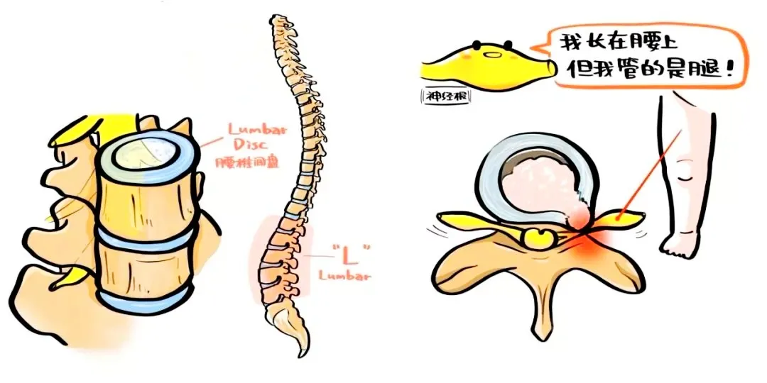 那麼,生活中腿怎麼疼可能是腰出現了問題呢?