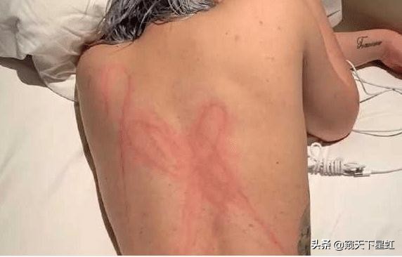 连环瓜？屈楚萧被前女友爆料玩SM，女方晒半裸照片，背上都是淤青