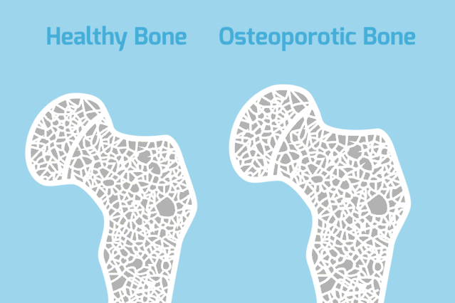 人人都避不開骨骼變老！ 退行性骨關節炎與骨質疏鬆理應早預防