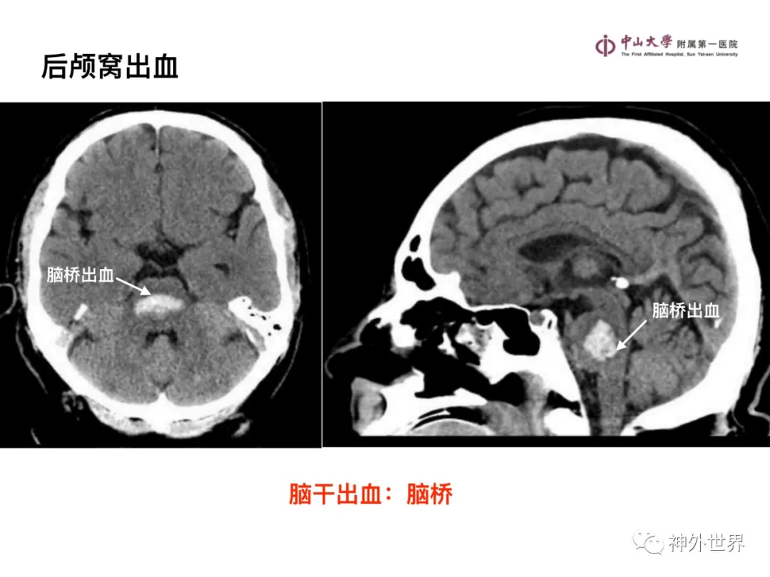 最全影像总结 | 颅内病变 MR、CT 的阅片技巧，太赞了