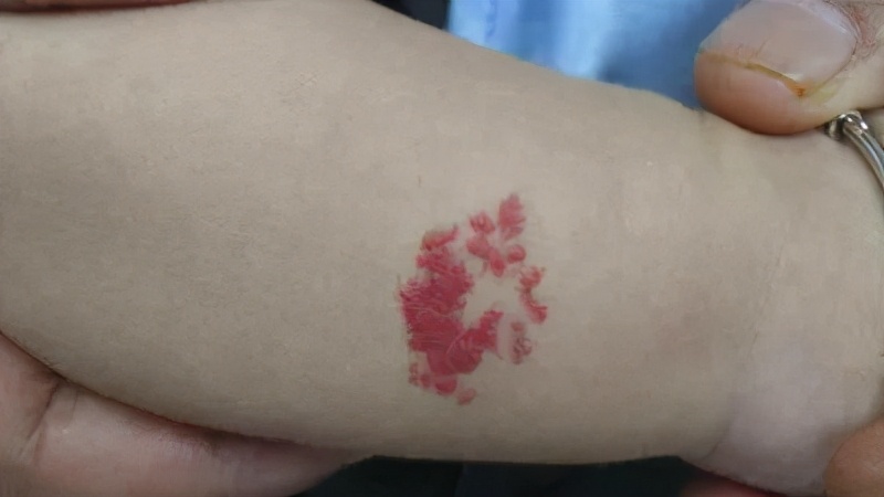 婴幼儿血管瘤服用普萘洛尔，这些细节不可忽视