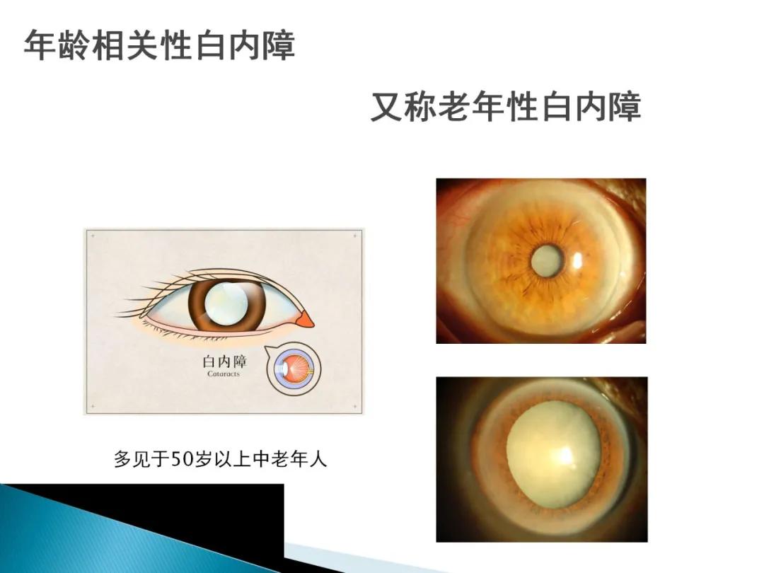 健康科普大赛获奖作品展示⑤|老年人常见眼部不适