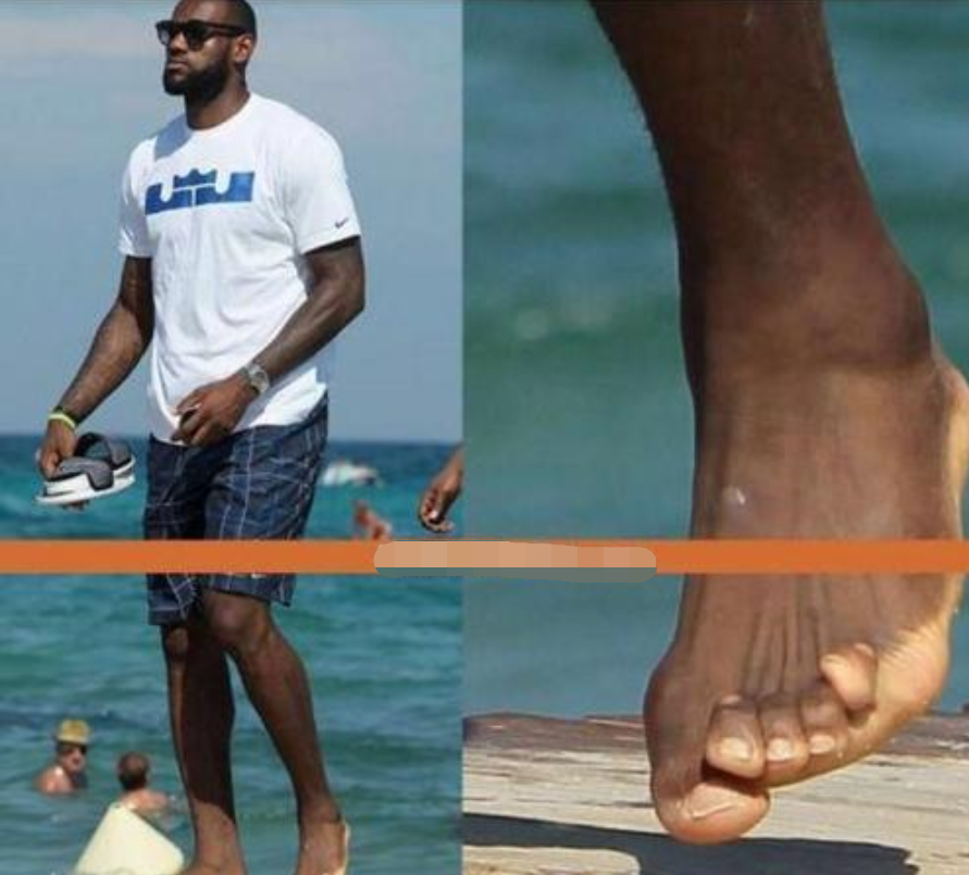 看照片才知打NBA多不易！羅斯膝蓋留長長傷疤，詹姆斯腳趾變形