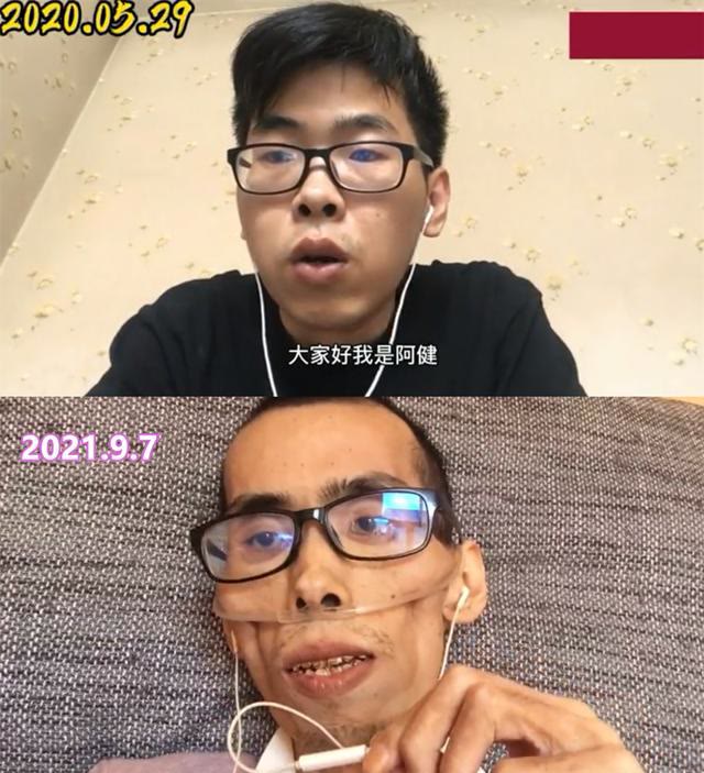 年輕小伙患癌300多天,骨瘦如柴宛如60歲老人:給家人留了爛攤子