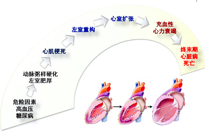 才50岁的人，高血压几年没治疗，心功能都不好了