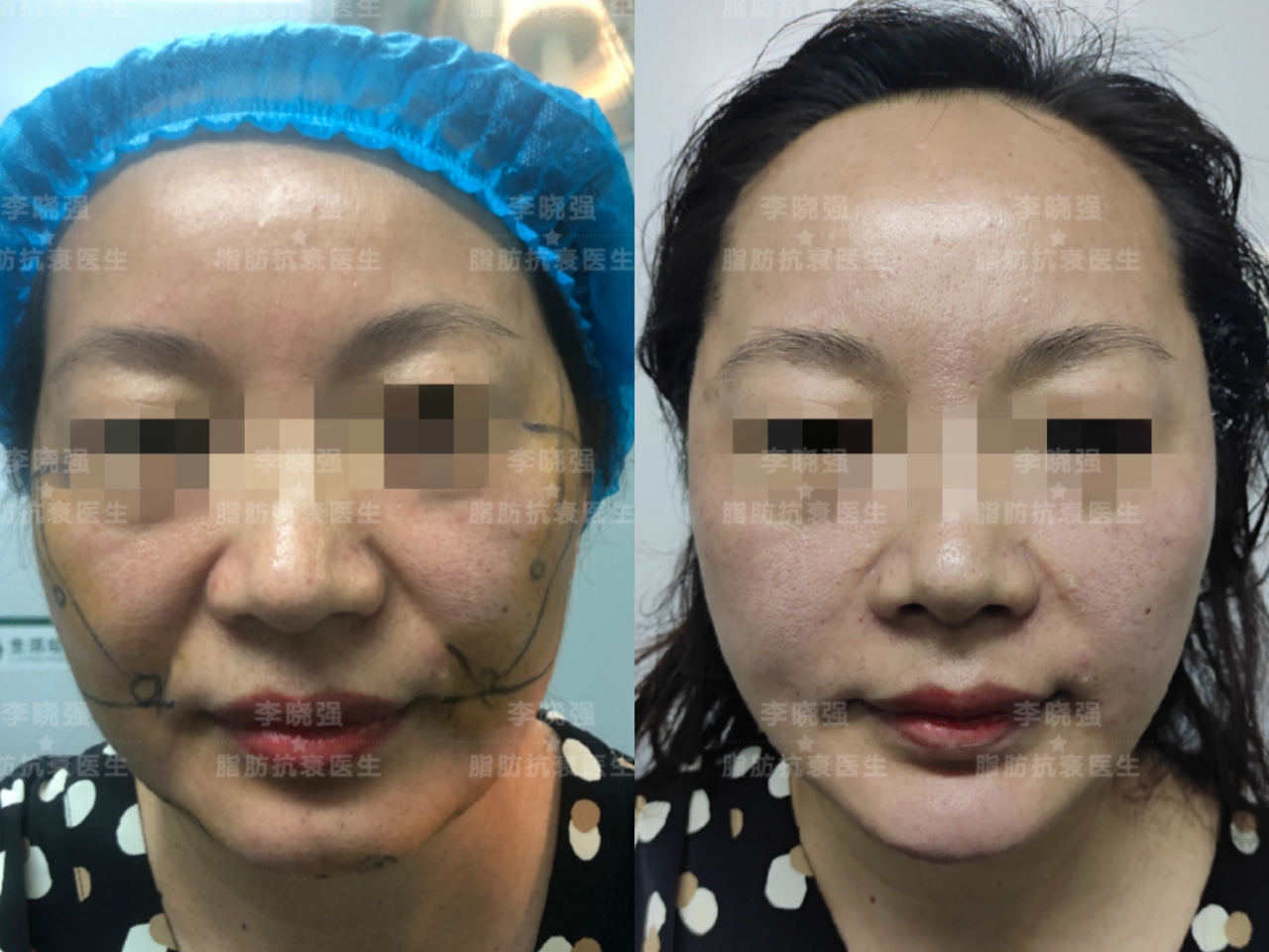 「真实案例」面部线雕的最全科普,看完再也不用担心被忽悠了