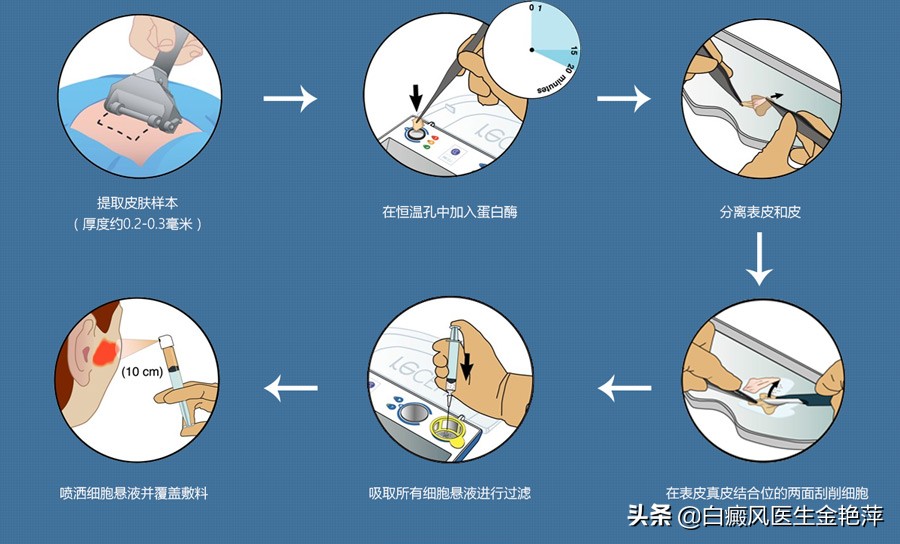 白癜风无扩散无增多、可以不用治、真的是这样么？