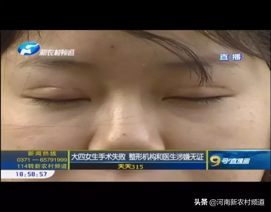 天天315 女大学生整形失败，3个月不敢出门