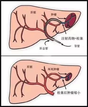 每年肝功检查都正常，为什么突然就诊断为肝癌？