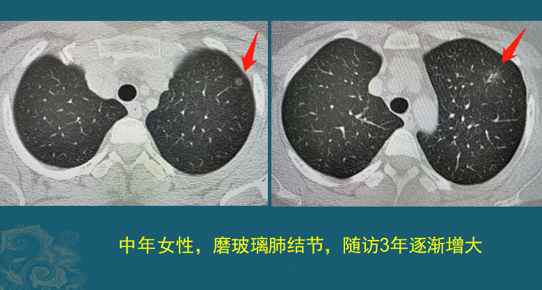 老人长5个肺癌，都不一样，有2个扩散，肺癌不能治愈吗？