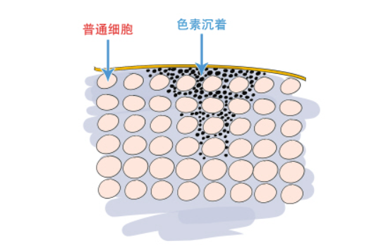 “皮肤有痘印”的女人，再缺钱也要试试这几款精华，助你告别痘印