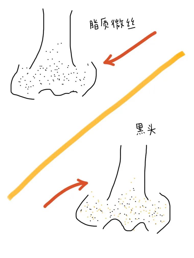 姐妹們原來這樣去黑頭才是正確的