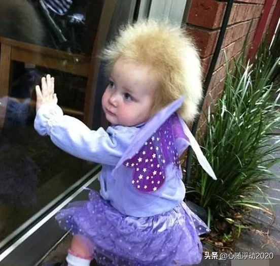 世界上最“奇特”的病，得病后不能洗头梳头，天天顶着爆炸头