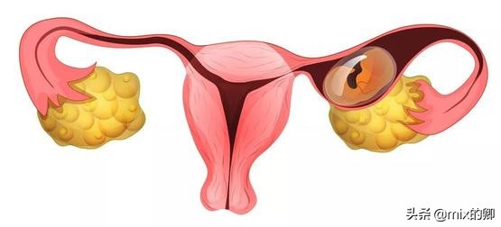 美國俄州驚悚法規：醫生必須把宮外孕的胚胎“裝回子宮”