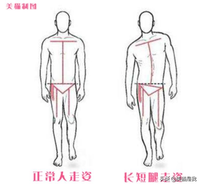 你不是腿短，可能是长短腿，如何辨别和矫正？