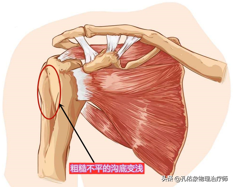 出现肩膀疼痛、活动困难就是肩周炎吗？医生辟谣，带您了解肩痛