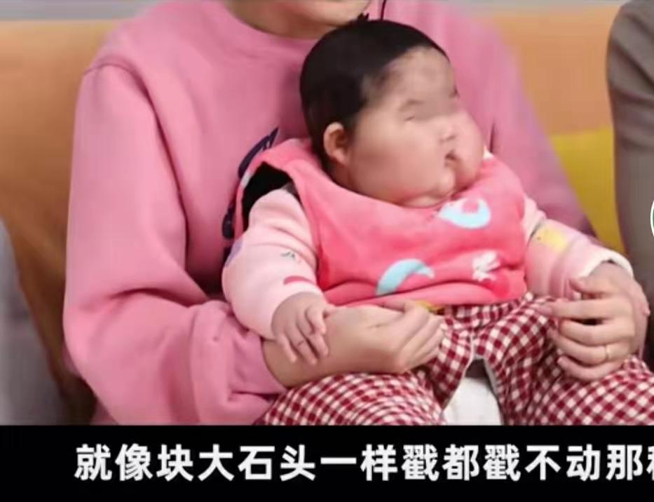因用护肤霜，3个月的婴儿额头长满浓密汗毛，体重猛增但身高不长