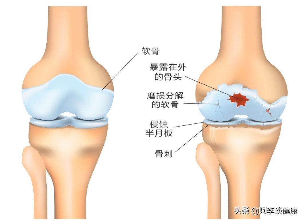 3个生活方式的改变 可以改善 预防你的膝盖骨关节炎 Mp头条