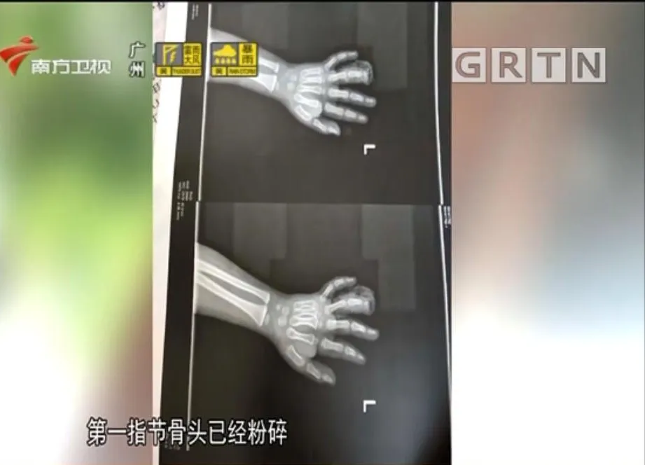 4岁男孩手指被这种健身器械所伤，导致截肢！很