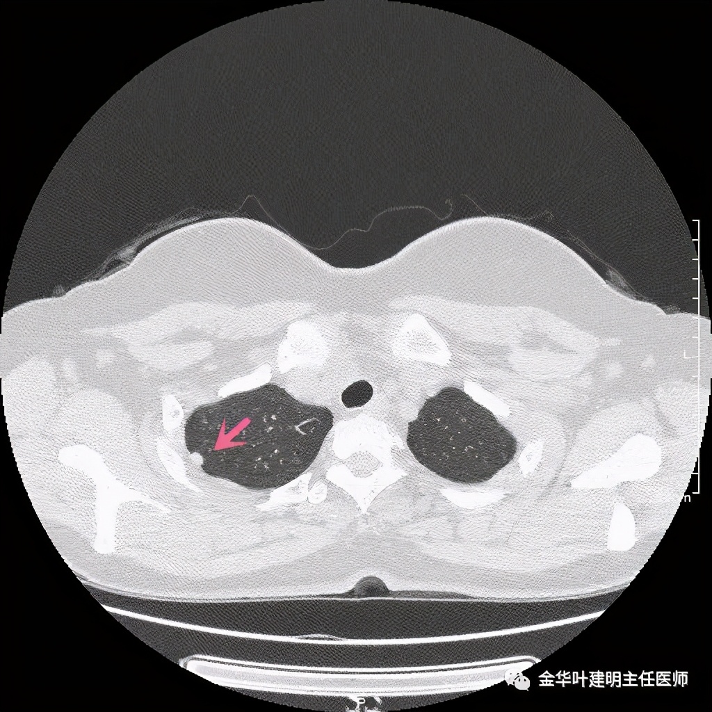 随访明显增大的实性<!--HAODF:8:jiejiebing-->肺结节<!--HAODF:/8:jiejiebing-->肯定是癌吗？要不要手术？