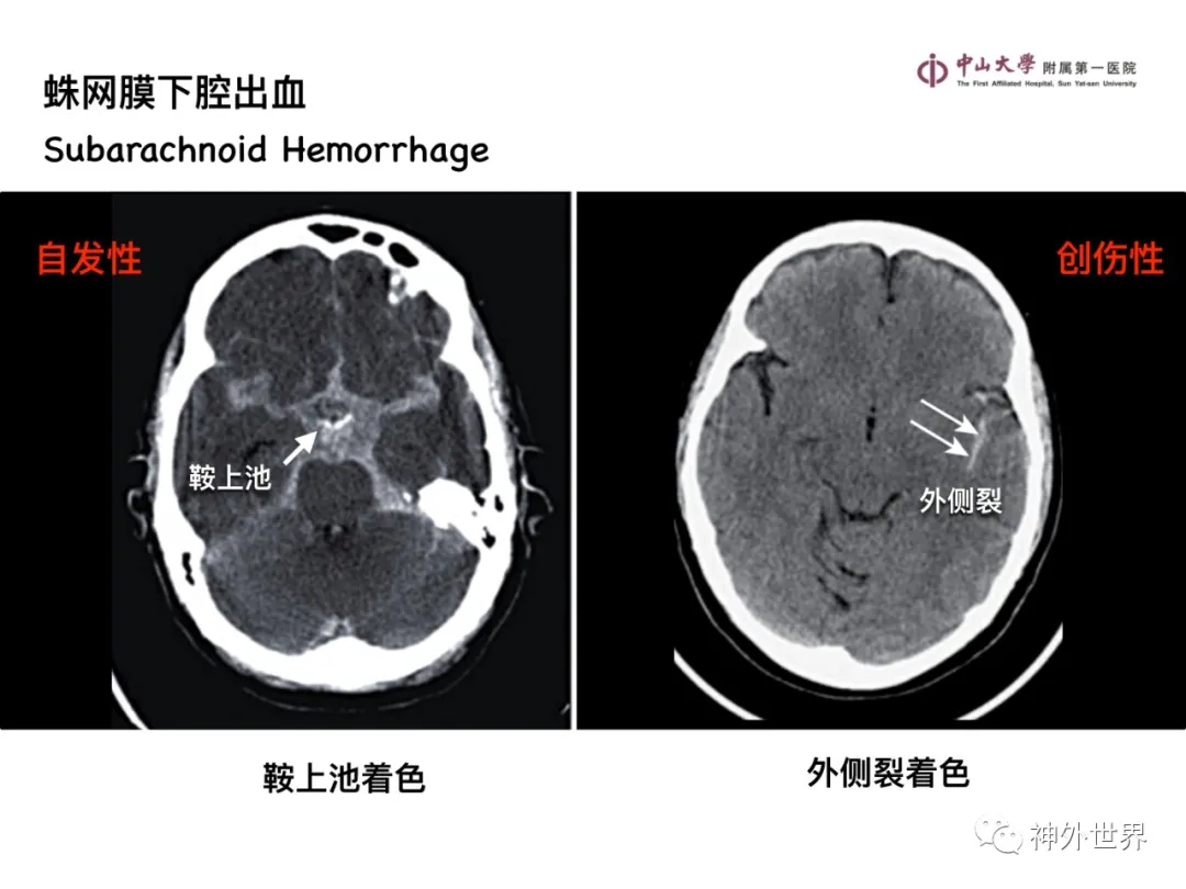 最全影像总结 | 颅内病变 MR、CT 的阅片技巧，太赞了