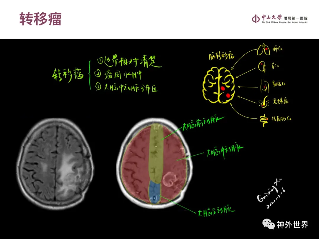 最全影像总结 | 颅内病变 MR、CT 的阅片技巧，太赞了
