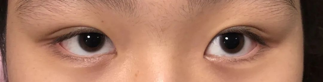 孩子近视了，要不要赶紧给点上低浓度阿托品