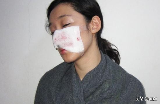 萧亚轩与男友被狗咬伤，黄皓如今无法出院，可能容貌受损