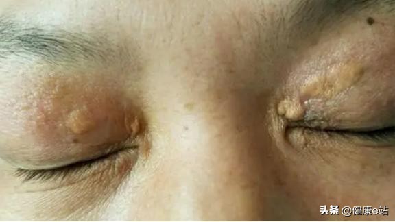 降血脂，及時預防是關鍵，5個“信號”提示你，血脂該控制一下了