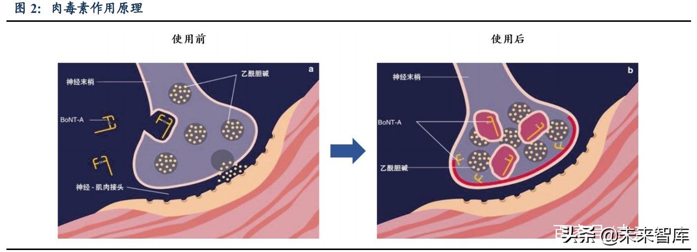 肉毒素市场研究：高门槛、强增长的医美上游注射产品