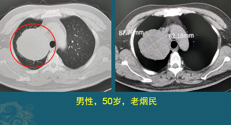 肺癌复发和转移的原因是什么？医生用2个病例，指导正确防癌